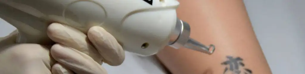 Eliminació de Tatuatges